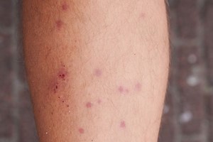 Mite Bites: What To Know