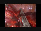 Uniportal VATS Left Upper Anatomic Segmentectomy S2 S4-5 • Video • MEDtube.net