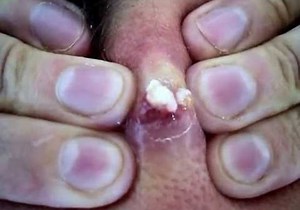 Close-Up Popping of Possibly the Biggest Zit in the World