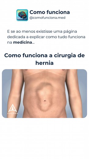 Como funciona a cirurgia de hérnia? 🩺 Na cirurgia, o médico faz um corte na região da hérnia, identifica o que está “saindo” pelo ponto de fraqueza da parede abdominal, coloca esse conteúdo de volta no lugar e depois fecha ou reforça essa área. Em muitos casos, esse reforço é feito com uma tela cirúrgica, que ajuda a dar mais sustentação à parede do abdome e diminuir a chance de a hérnia voltar. Quando a hérnia é menor, em alguns casos o fechamento pode ser feito apenas com pontos. Depois disso