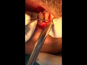Flap Surgery steps and procedure