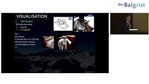 Diagnosis and Repair of Subscapularis Tears