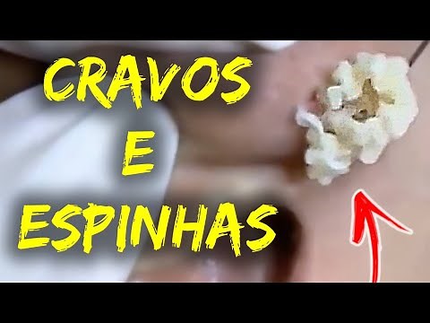 Como Remover Cravos do Rosto - Removendo CRAVOS e ESPINHAS GIGANTES #015