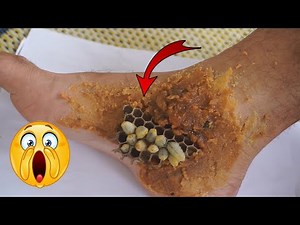 [ Tiny worm On Feet ] Dandruff Scratching and moving worm nest on man's feet
