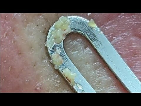Pimple Popping and Sebum Explosion | Self Extraction #48 #pimplepopping #acne #pimple #sebum