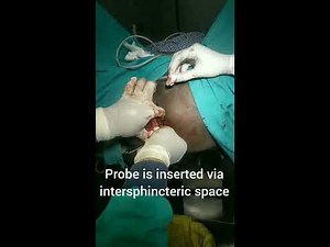 KSHARSUTRA WITH TROPIS CONCEPT IN COMPLICATED FISTULA SURGERY DR JAY MAKADIA GREENLIFE HOSPITAL.