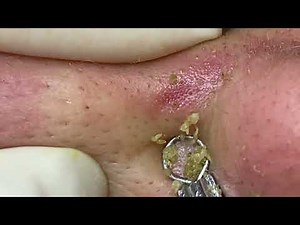 #3|2025 Extreme Blackhead Removal on Nose | LyLyBeautySpa