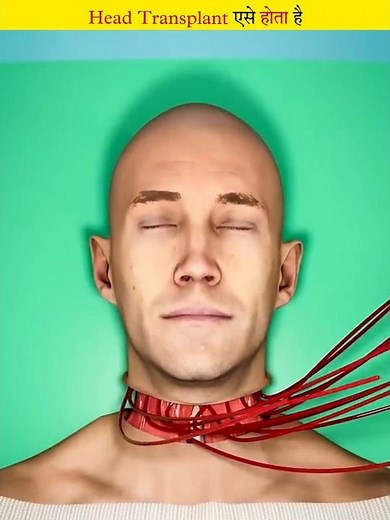 This is how Full Body Transplant happens