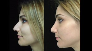 Scarless Closed Rhinoplasty Before and After Results