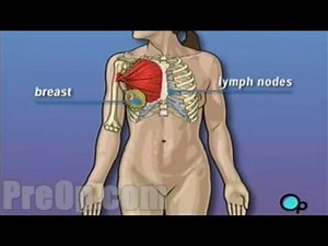 Mastectomy Total Breast Surgery PreOp® Patient Education Medical Videos