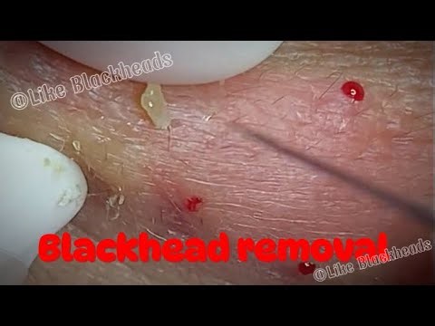 HOT: Dr. Blackhead removal, Pimple popping new this week #11