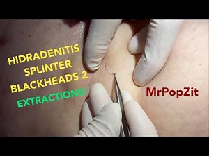 HIDRADENITIS causes splinter blackheads.Watch me pull out the plugs from her armpits.Instant relief!