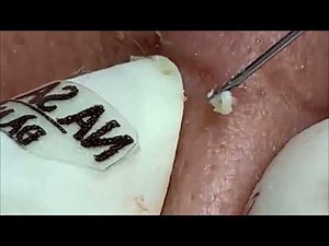 Watch This Giant Blackhead Get Popped!#015