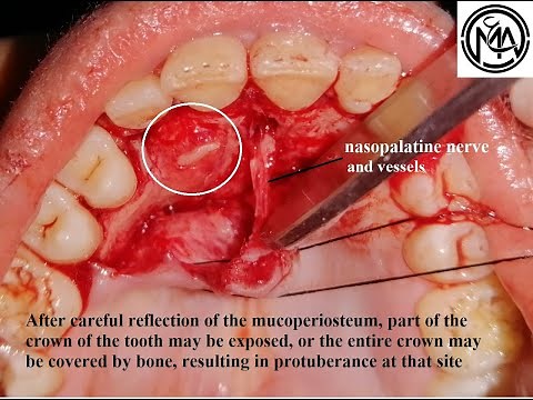 Surgical Extraction of palatally Impacted canine