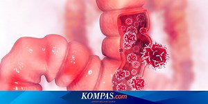 Tanda-tanda Kanker Usus Besar dari Stadium Awal dan Akhir