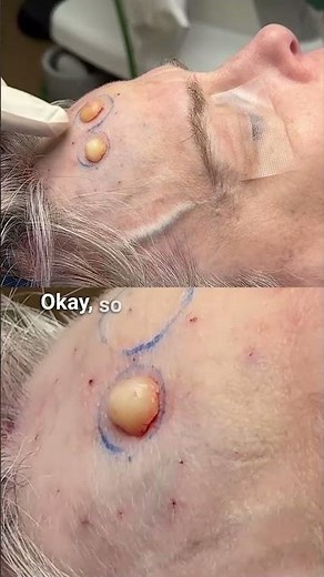 Endoscopic Osteomas Removal #osteoma #facialsurgery #endoscopic #plasticsurgery