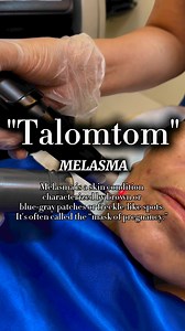 BATTLING MELASMA / Once you have melasma and even if you do not desire or seek dermatology or laser treatment, the number one rule is AVOID SUNLIGHT! That means no beach, pool activities and outdoor activities, including but not limited to, motorycyle rides. More sunlight will only worsen melasma. There are no melasma quick-fix and not all lasers or chemical peels work in treating melasma. The right tool and expertise for thr right job. Vist our clinics for melasma treatment options. See you! 📸