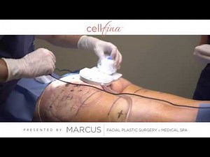 New Cellulite Treatment | Cellfina