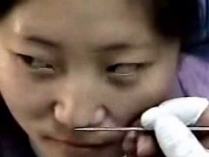 How to do a demodex mite test