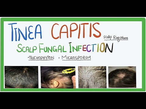 Tinea Capitis |fungal infection of scalp| causes, transmission, clinical features and Treatment