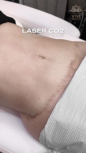 10K views |  Láser CO₂ para Cicatrices  Mejora la apariencia de...