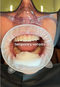 Temporary Veneers to Permanent Veneers: What to Expect in 2 Weeks