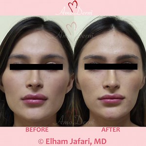  Jaw slimming with Botox ____  Procedure: Injection of Botox to...