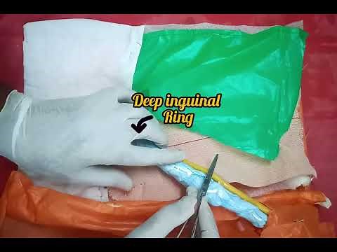 Lichtenstein tension free hernioplasty - inguinal hernia repair