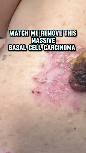 Basal cell carcinoma (BCC) is the most common type of skin cancer, arising from the basal cells in the epidermis. It typically occurs due to prolonged exposure to ultraviolet (UV) radiation from the sun or tanning beds. There are four main clinical variants of basal cell carcinoma. These are nodular, superficial spreading, sclerosing and pigmented basal cell carcinomas.BCC usually appears as a painless, raised area of skin. Contact Dr. Kerr today for advanced treatment options if you think you m
