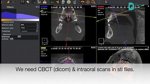 We need CBCT (dicom) & intraoral scans in stl files. Then Lab....