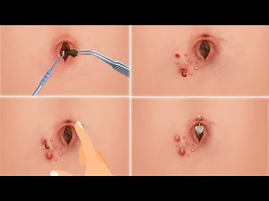 ASMR Remove Navel Stone Animation | Is Your Belly Button Clean? . . Enjoy 😍😊