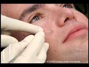 Infraorbital Injection