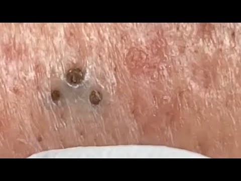 Blackheads