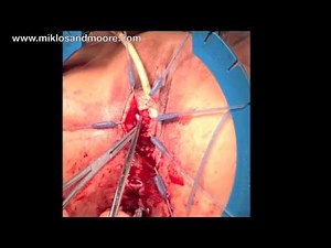 TOT sling removal - Vaginal Pain / Difficulty Emptying Bladder Drs. Miklos Moore