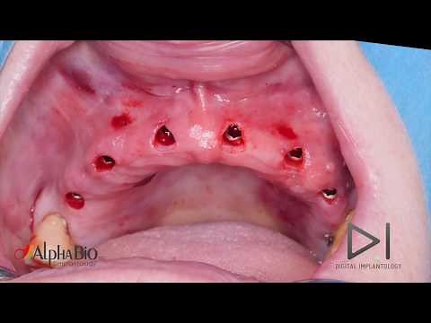 Guided Surgery operation | Alpha-Bio Tec.