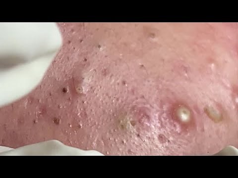 Make your Acne Treatment Huong Da Nang | 423 # acne 2022