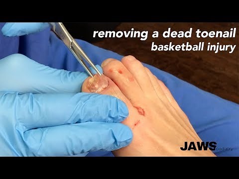 REMOVING A DEAD TOENAIL - more satisfying than removing an ingrown toenail!!