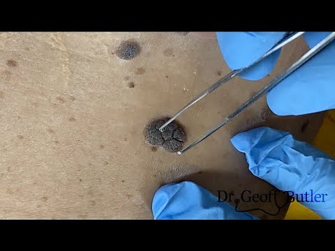 Removal of Seborrheic Keratoses