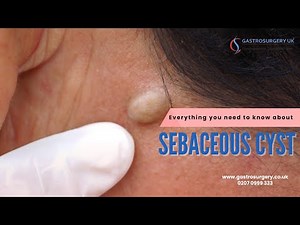 What is a Sebaceous Cyst? Everything you need to know about sebaceous cysts | Epidermoid Cyst