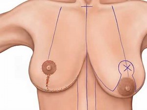 Anchor-Style Mastopexy Animation