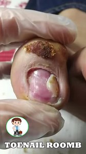 18K views · 107 reactions | #Reels Amazing Deep Thick nail cutter Big ingrown toenail Treatment  DIY pedicure P#13305 | Atlas Professional Risk Management | Facebook
