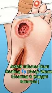 ASMR Infected Foot Healing 👣 | Deep Wound Cleaning & Maggot Removal | Satisfying Foot Care #shorts #reels #3danimation #satisfying #trending #video #cleaning #shorts #footcare | Akhilesh Yadav