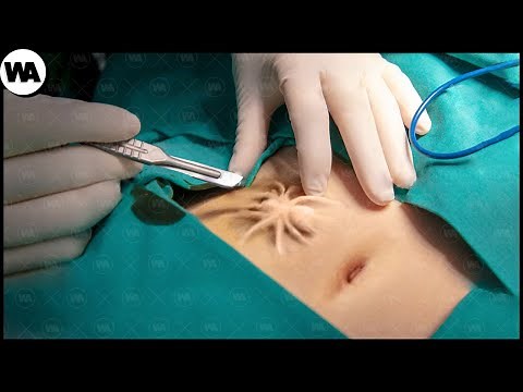 Spider Confused Its Burrow With a Wound and Went Under the Skin