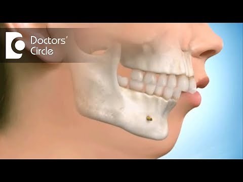 Can Open Bite be corrected by Orthognathic Surgeries? - Dr. Sumanth M Shetty