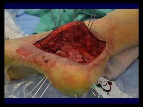 Calcaneal fractures - Operative techniques (OTA lecture series IV L15c)