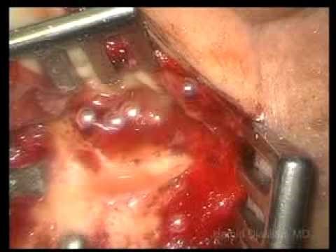 Right tympanoplasty with mastoidectomy