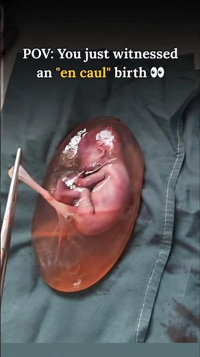 Amazing Baby Delivered in the Sac.