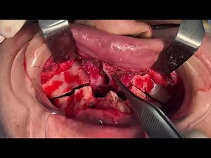 The Surgery behind Underbite or gummy Smile correction - upper Jaw Surgery