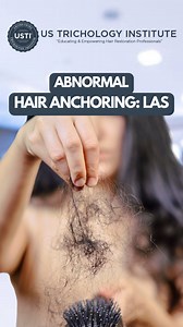 Abnormal Hair Anchoring: Known as LAS or Loose Anagen Syndrome. . . . #HairLoss #Alopecia #HairTransplant #HairGrowth #ThinningHair #HairRestoration #Baldness #HairLossTreatment #HairLossSolutions #Balding | United States Trichology Institute