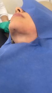 11K views · 19 reactions | Cirugía de lipo de papada | Bichectomia Reynosa | Facebook